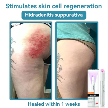 ✨QIAWI™ All-in-One CO₂ Laser Eraser Pen | Removes Moles, Warts, Skin Flaws & Pigmentation